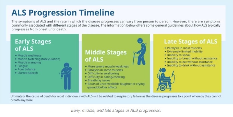 Early, middle, and late stages of ALS progression.